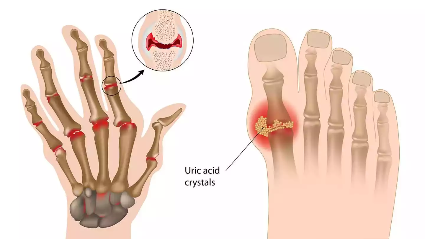 Stem Cell Therapy for Arthritis