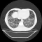 Dermatomyositis