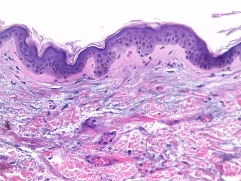 Stem Cell Therapy for Dermatomyositis