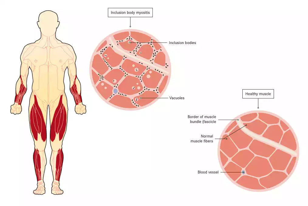 Stem Cell Therapy for Inclusion Body Myositis