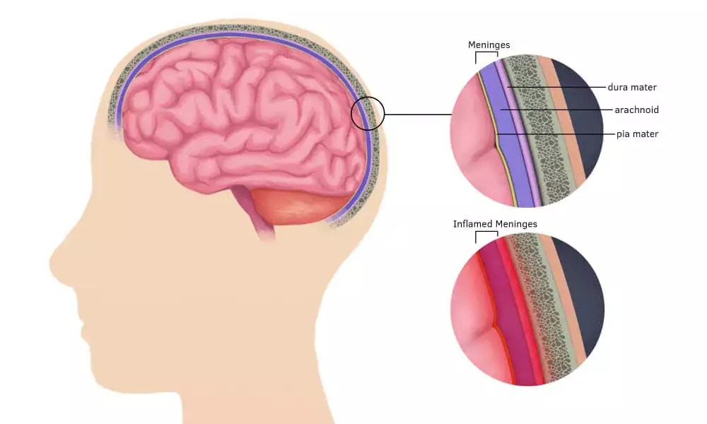 Stem Cell Therapy for Meningitis