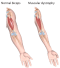 stem cell therapy for Muscular Dystrophy
