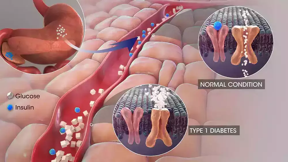 Stem Cell Treatment Diabetes type 1