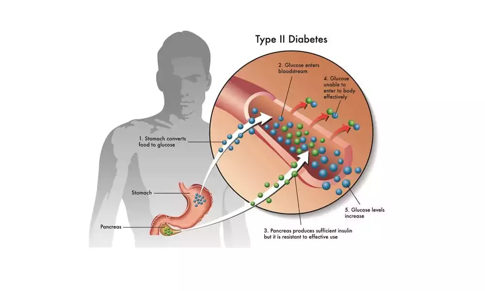 Stem Cell Treatment for Diabetes Type 2