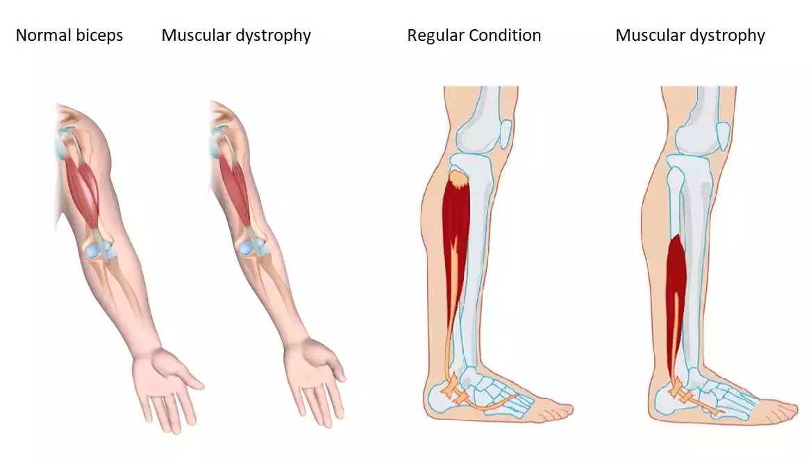 Stem Cell Treatment for Muscular Dystrophy