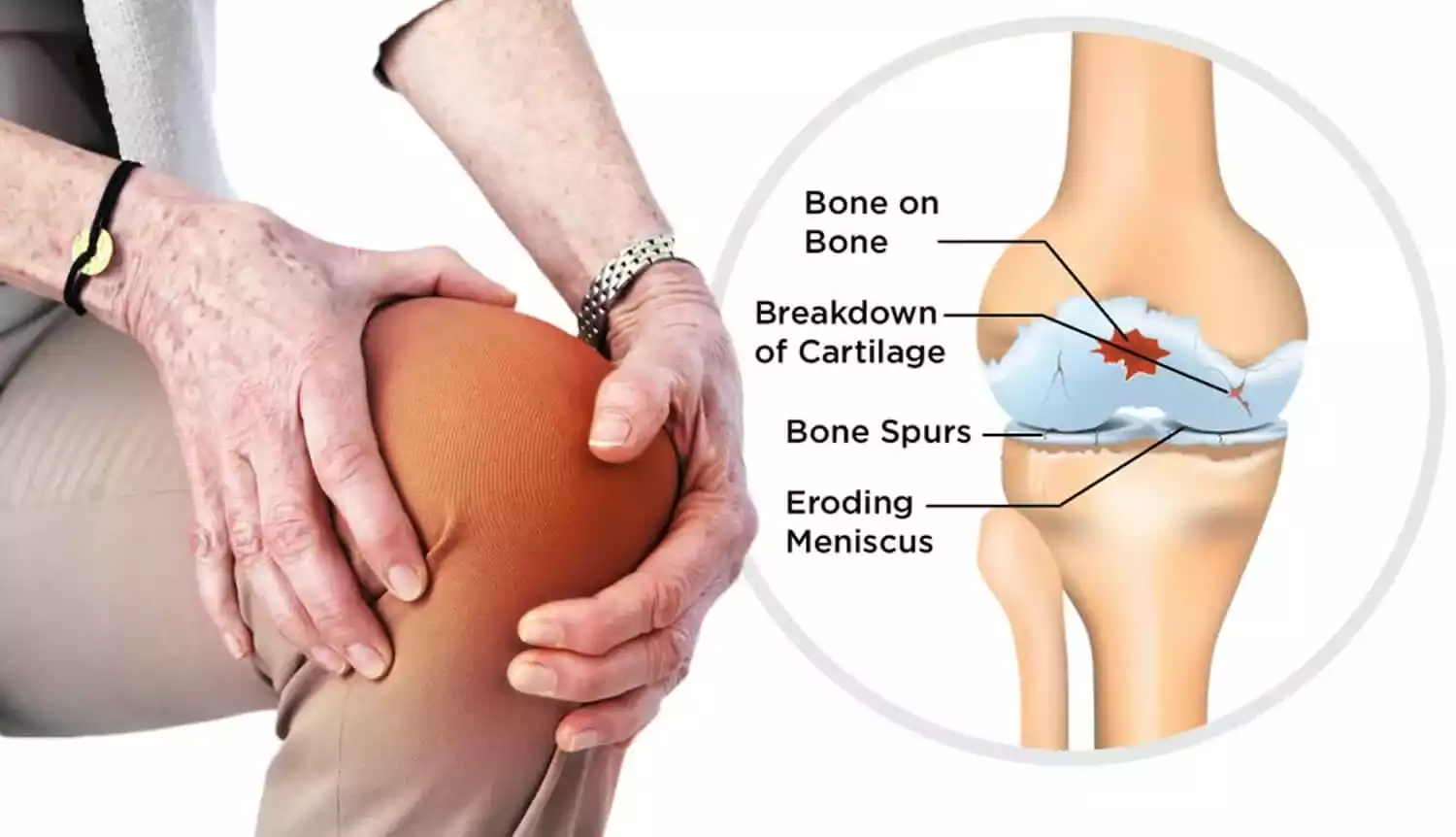 Stem Cell Treatment for Osteoarthritis